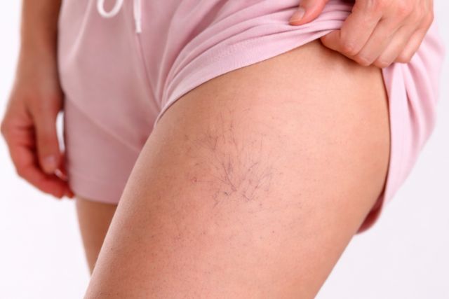 what causes veins to pop out in arms and hands​